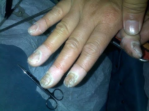 Gribok des Nagels von der Kindheit Die verfügbare Behandlung gribka des Nagels