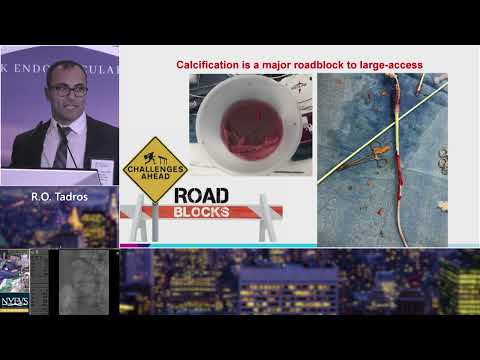 Role of Lithotripsy in Complex Calcified Iliac Interventions   R  O  Tadros   PAD Session