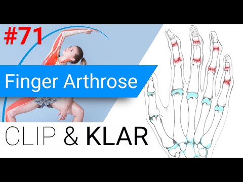 Finger Arthrose erklärt - Kleine Gelenke, grosse Einschränkung