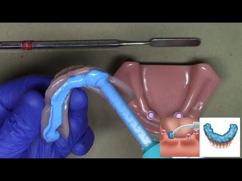 Laboratory Reline for LOCATOR and LOCATOR R-Tx Dentures: Step-By-Step Technique