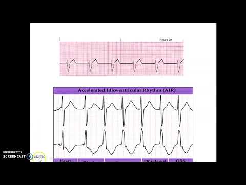 Accelerated Idioventricular Rhythm