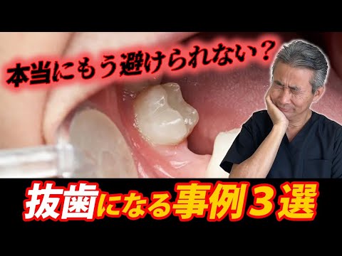 歯学科 【危険】もう抜かないとダメ？ 抜歯になる事例3選 徹底解説　「ヒロ横浜デンタル」 「精密根管治療」