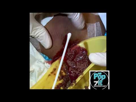 HUGE INFLAMED CYST/ABSCESS POP. Squirts over 3 feet. Cyst squirt. Cyst explosion. MrPopZit