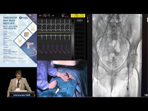 G. Pattakos | Live-in-a-box TAVR | TAVR Session IV – Avoiding Pitfalls