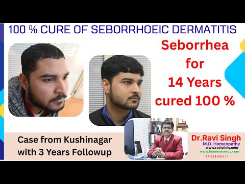Cure of 14 years long seborrhoeic Dermatitis with 3 years followup