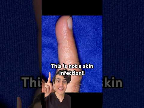 Bubbles on the hands or feet? Dermatologist explains #itchyfeet #eczema #eczemaawareness