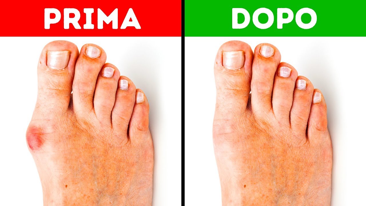 5 Modi Efficaci per Sbarazzarsi dell’Alluce Valgo