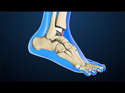 Total Ankle Replacement Surgery | Nucleus Health
