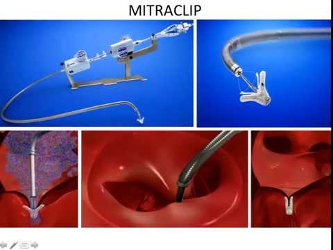 Dr Peter Hansen: Transcatheter Mitral Valve Therapies