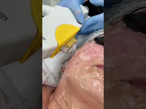 🌟 LASEROWE USUWANIE PRZEBARWIEŃ – MUST HAVE W GABINECIE BEAUTY!