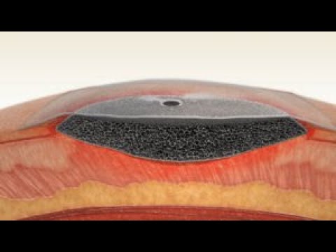 3M™ V.A.C.® Dressing Application Basic Technique Video