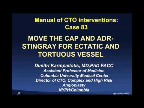 Case 83: Manual of CTO Interventions: - Move the cap and ADR for ectatic and tortuous vessel