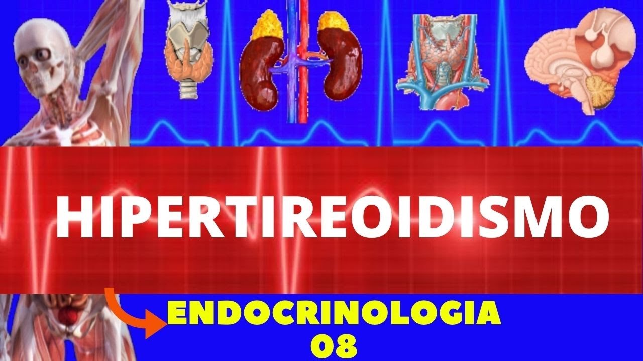 HIPERTIREOIDISMO (CAUSAS, SINTOMAS, DIAGNÓSTICO E TRATAMENTO) - ENDOCRINOLOGIA