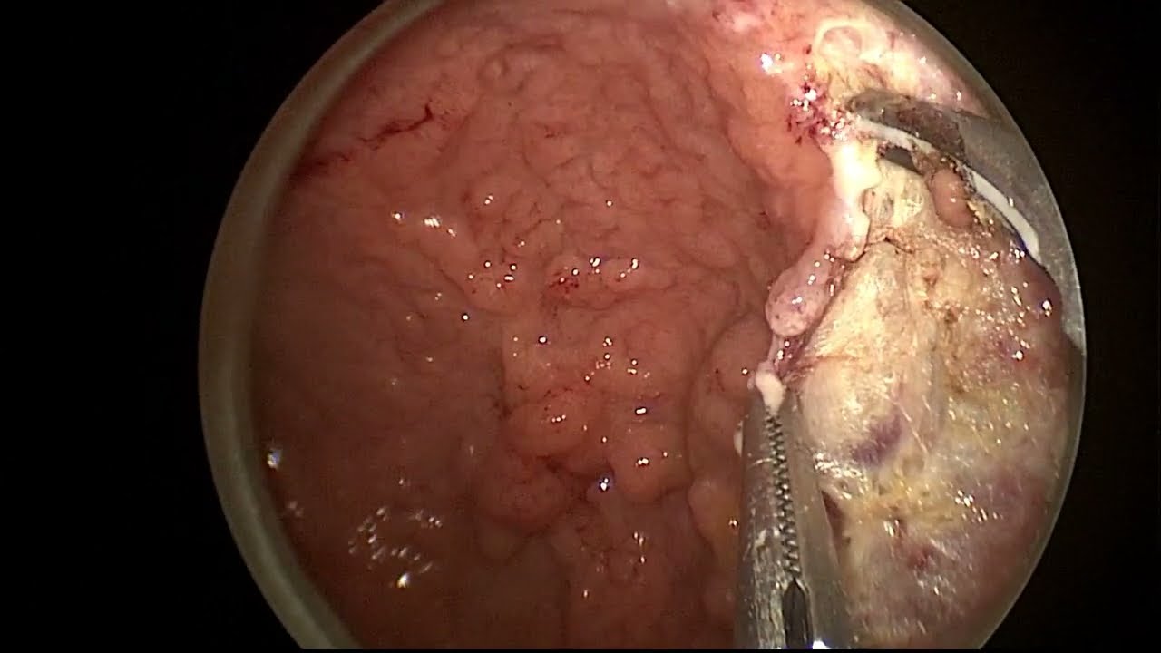 TEO - transanal endoscopic operation