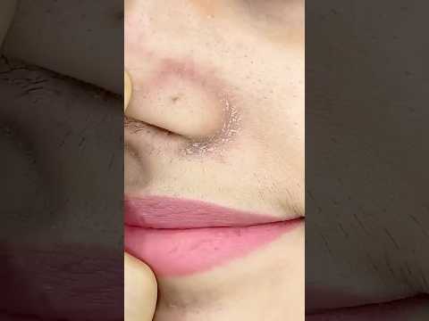 Easy Way Removal Nose Blackhead & Whiteheads at Home Remedy #shorts #youtubeshorts #trendinghacks