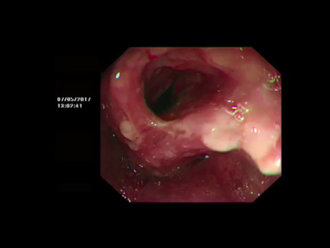 gége tracheobronchialis papillomatosis pinworms gyógyszerek az ellenük való küzdelem érdekében