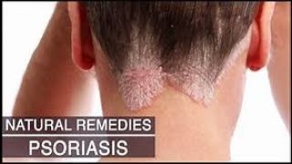 how to remove psoriasis scales from scalp naturally