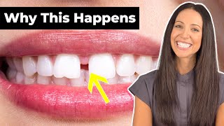 Why Do People Have GAP TEETH & How To Fix It (Diastema Explained)