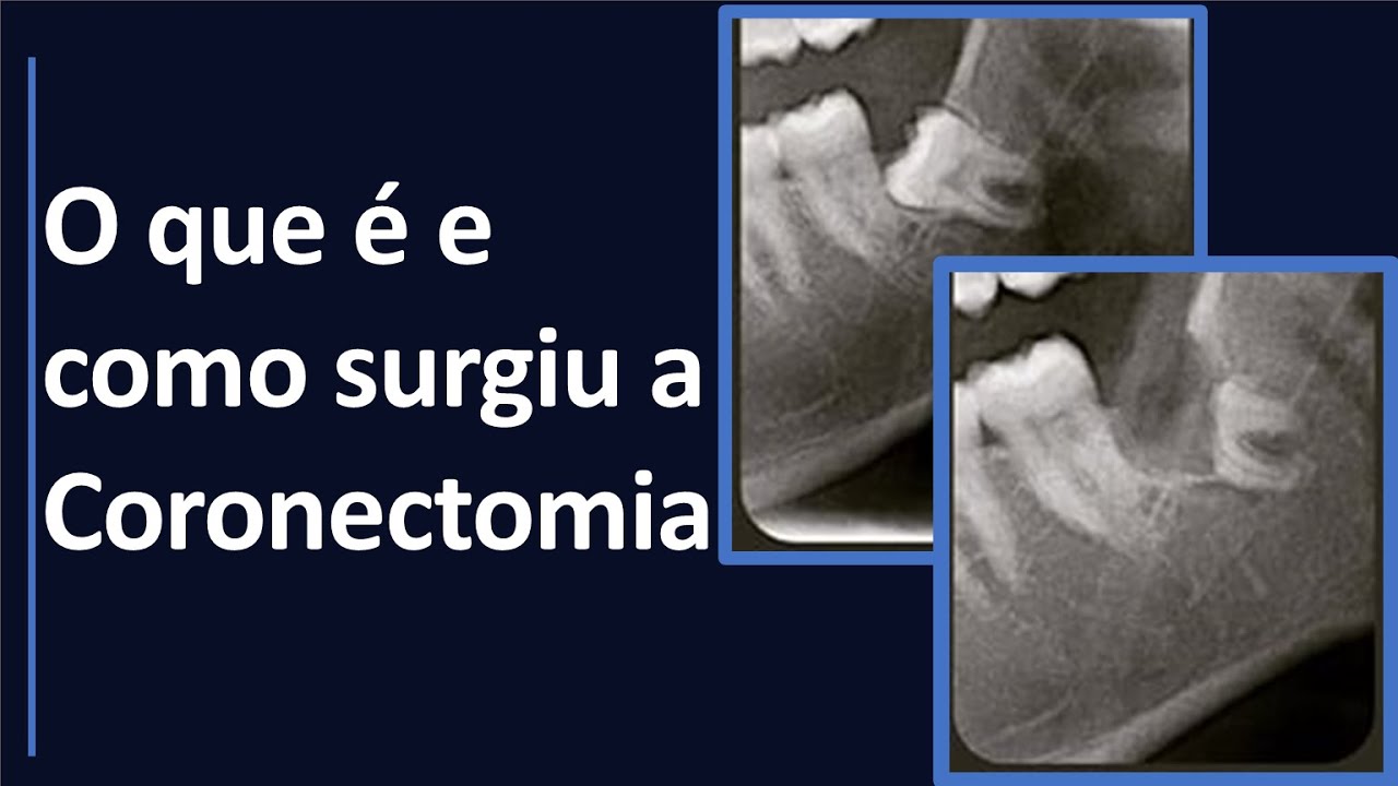 O que é e como surgiu a Coronectomia  | Odontologia | Dra Bianca Rosa