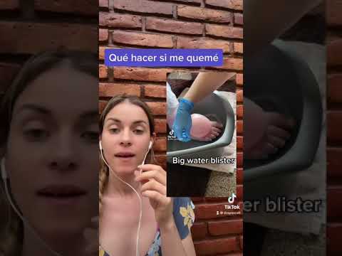Qué hacer con una quemadura?