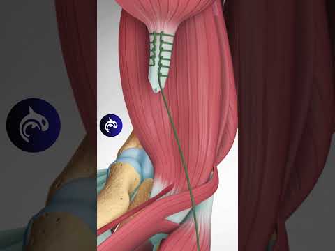 Elbow Olecranon Fracture and Fixation 3D Animation