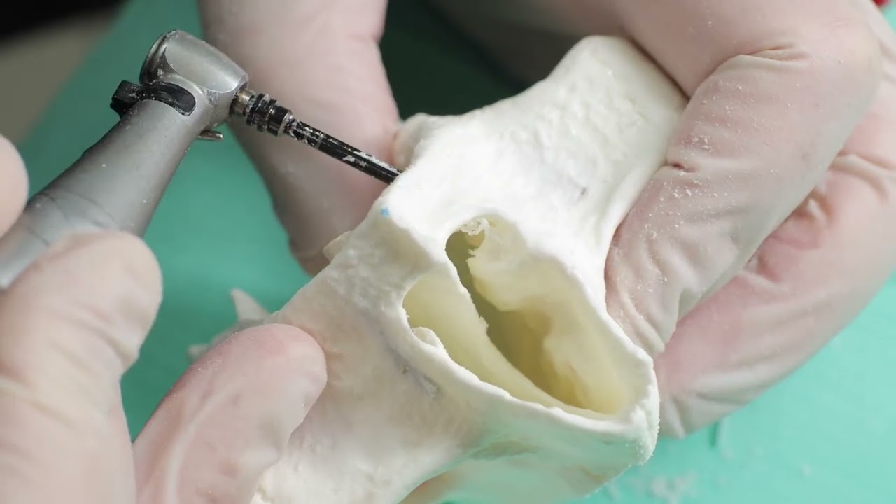 Nasal implants: practical demonstration on a model by Dr Marcello Provvisionato