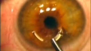 Direct Keraring implantation without tunnel dilatation