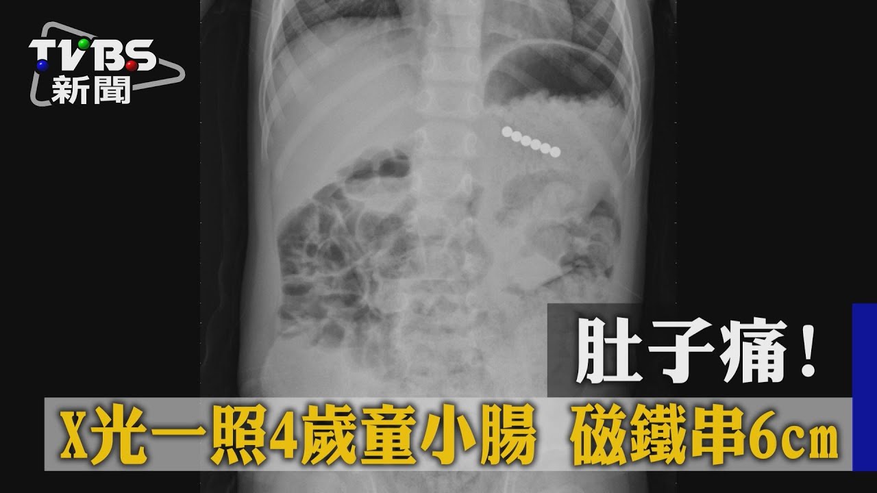 肚子痛!X光一照4歲童小腸 磁鐵串6cm