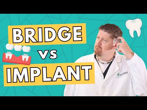 Dental Bridge vs Dental Implant | Costs, Pros and Cons, Which to Choose?