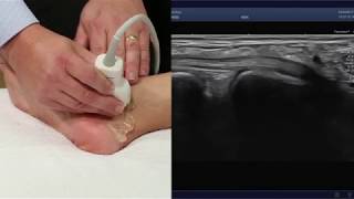 Imaging the Ankle Using the Aplio i800u00a0Ultrasound