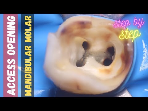 Access Opening in Mandibular Molar - Mandibular First Molar - Step By Step Demonstration