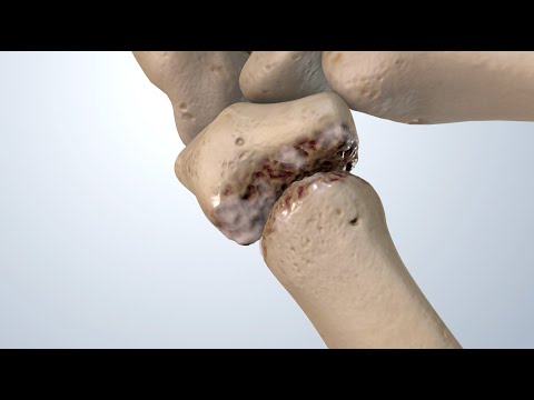 Osteoarthritis of the Thumb