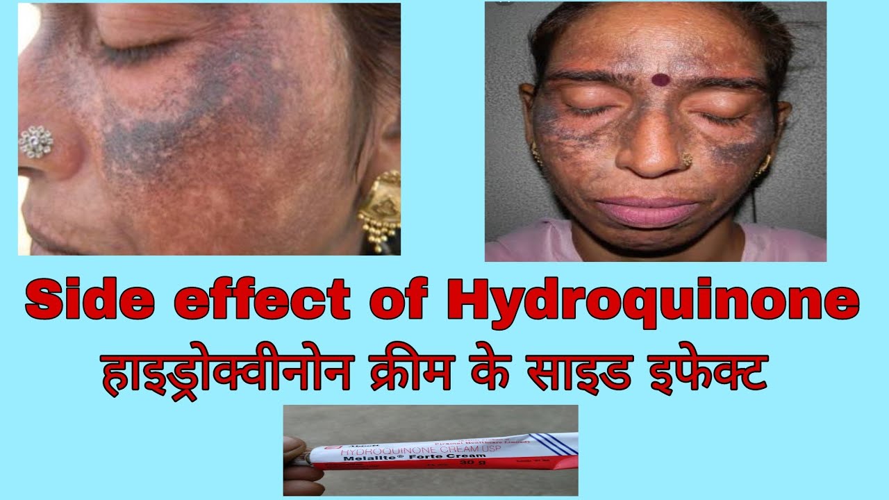 Hydroquinon cream side effects in hindi..malalite fort cream review