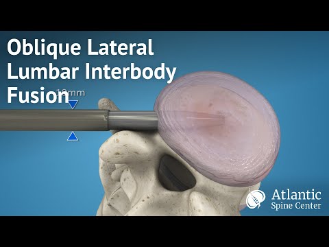 Oblique Lateral Lumbar Interbody Fusion (OLLIF)