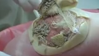 Maggot Debridement Therapy (MDT)