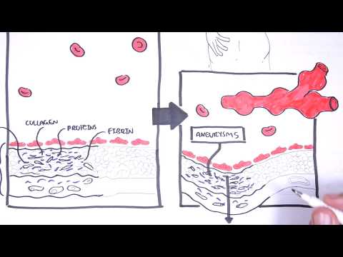 Polyarteritis Nodosa und Kawasaki-Krankheit – Symptome, Pathophysiologie