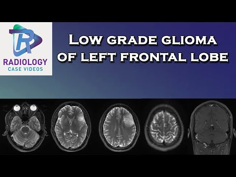 Low grade glioma of left frontal lobe