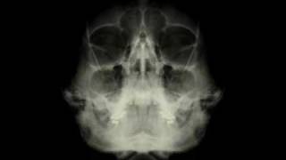 Severance - MyChildren MyBride