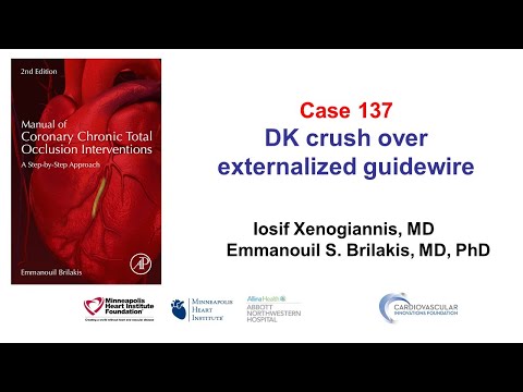 Case 137: Manual of CTO PCI - DK crush over externalized guidewire