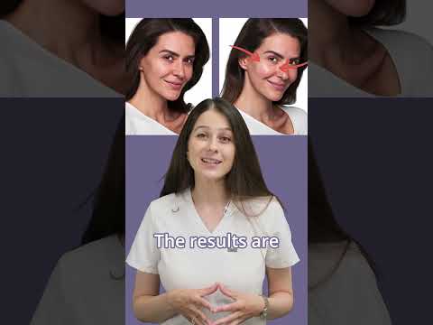 SkinVive skin booster​: Before and After