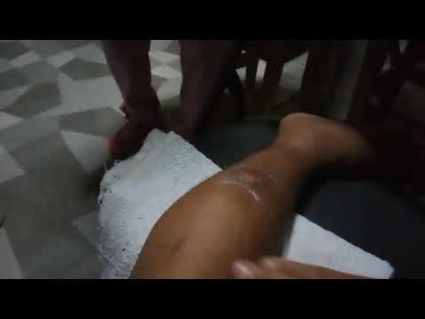 Ano ang pinakamahusay na cream ng halamang-singaw sa kanyang mga paa Toe halamang-singaw sintomas at paggamot