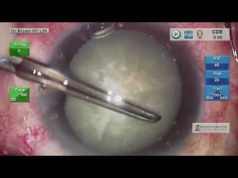 Complicated cataract Surgery : Phaco a milky white and dense cataract case without staining