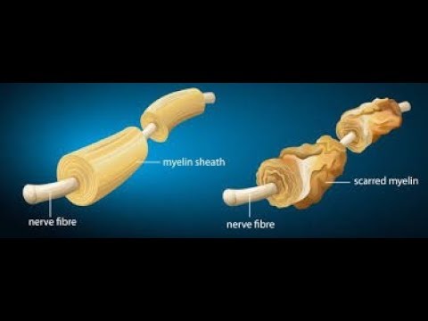 Multipla skleroza može da se uspešno tretira!