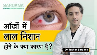 Causes of Red Spot in Eye| Aankho me Khoon Aana  | Eye Specialist in Delhi | Dr. Tushar Sardana