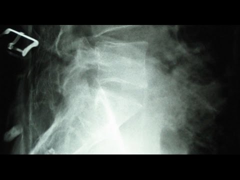 Video Explanation: What are Vertebral Compression Fractures?