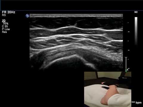 trochanteric bursa movement ultrasound