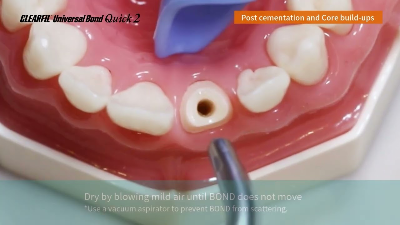 4. Post Cementation and Core Build Up