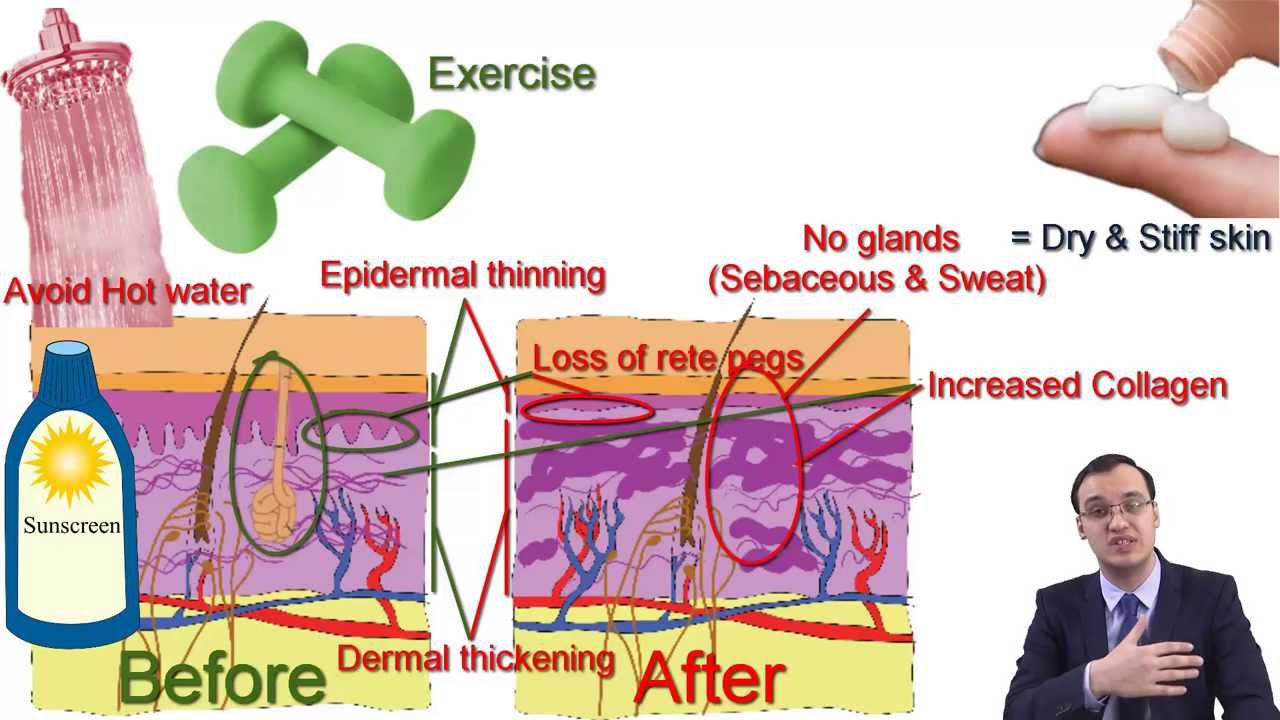 Scleroderma (Systemic sclerosis) - YouTube