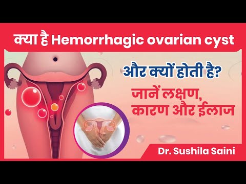 How dangerous is Hemorrhagic Cyst in Ovary? Know what effect it has on pregnancy?