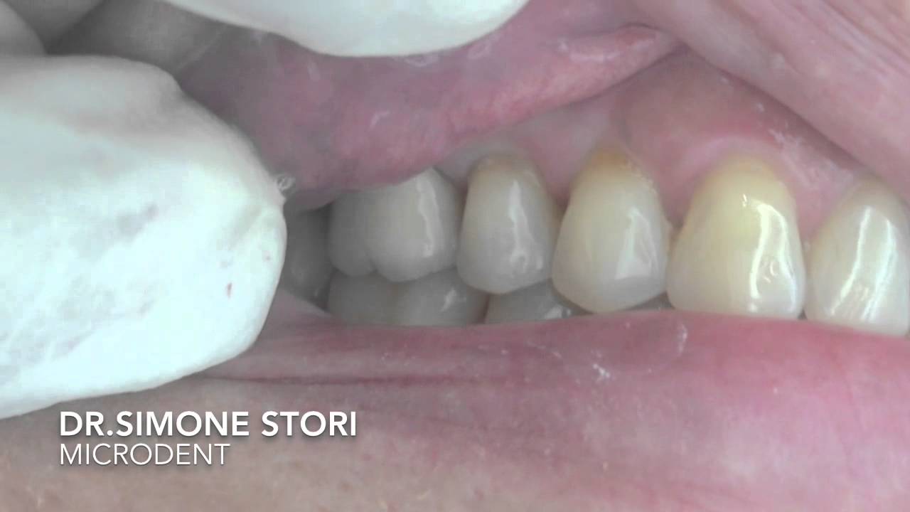 Dente affetto da Parodontite Severa Curato con Laser